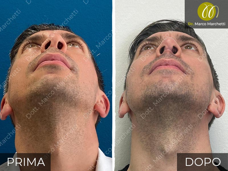 Prima E Dopo Rinoplastica Rinoplastica Milano Prima E Dopo Rinoplastica Rinoplastica Milano
